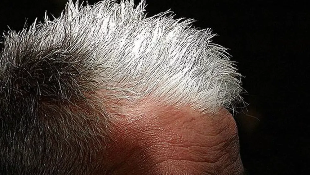 BEYAZ SAÇ VÜCUDUN KENDİNİ KANSERE KARŞI KORUMA YOLU OLABİLİR