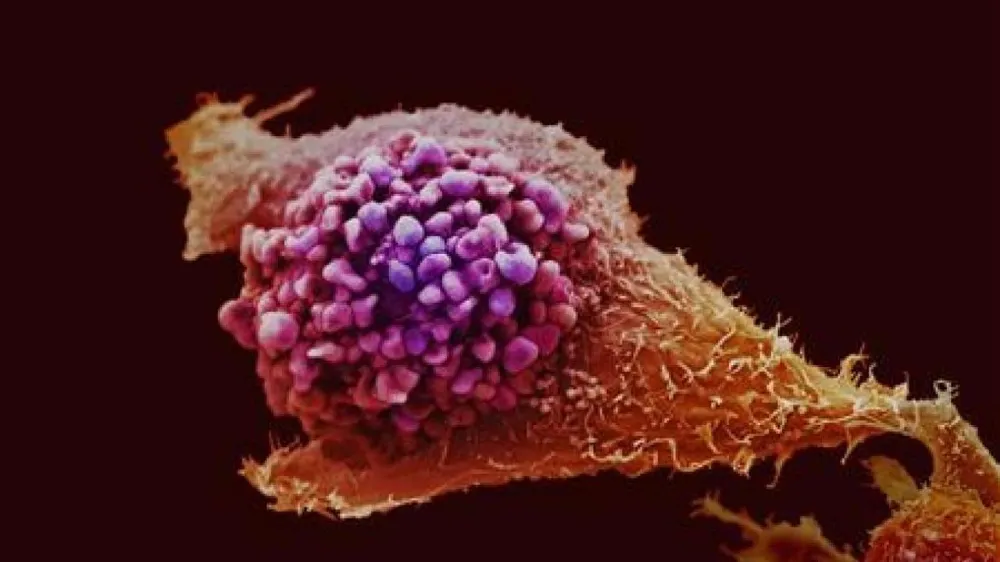 PROSTAT KANSERİ TARAMASINDA DEVRİM